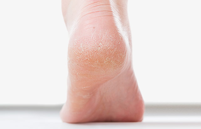 Wellneo Supreme Callus Remover